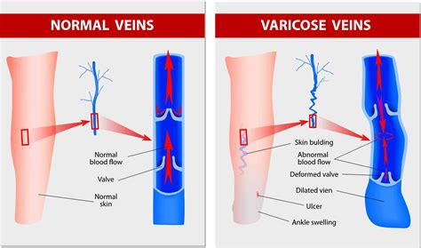 Understanding Varicose Veins: Causes, Symptoms, and Treatments