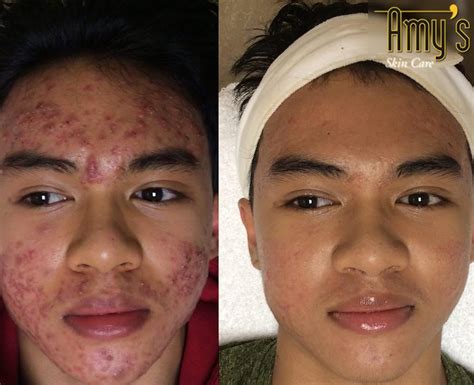 Acne Treatment Houston - Amy's Skincare & Med Spa