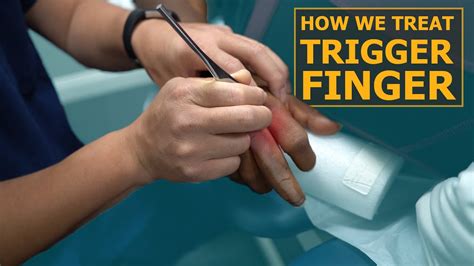 How We Treat Trigger Finger | Physical Therapy - YouTube