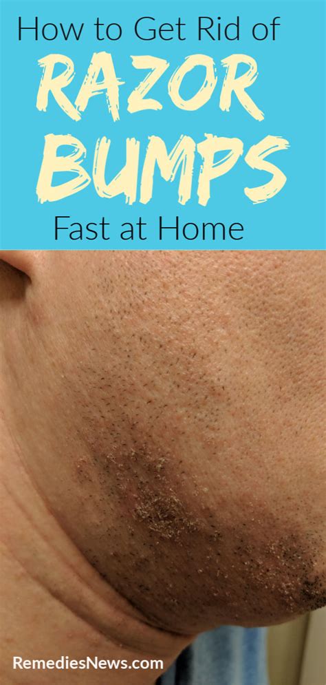 How to Get Rid of Razor Bumps Fast with 13 Home Remedies that Work