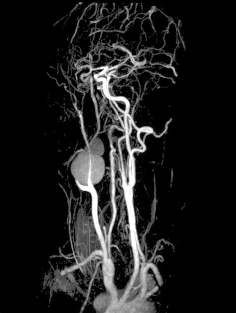 Carotid Aneurysm Photograph by Zephyr/science Photo Library - Pixels