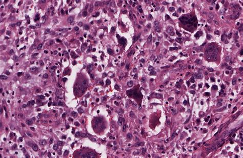 Pathology Outlines - Anaplastic thyroid carcinoma