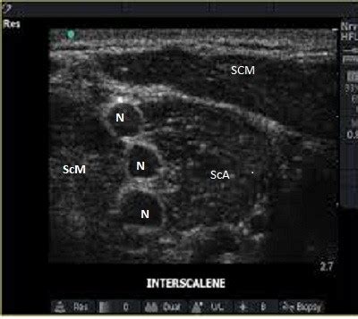 Ultrasound guided brachial plexus block – Anaesthesia, Pain & Intensive Care