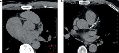 Role of coronary artery calcium score in the primary prevention of cardiovascular disease | The BMJ