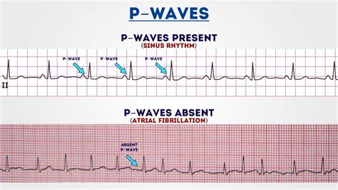 How to Read an ECG | ECG Interpretation | EKG | Geeky Medics