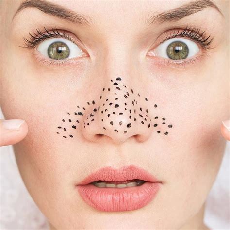 What Is A Blackhead: Causes, Symptoms & Treatments - StarBiz.com