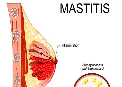 Can you get mastitis if you are not breastfeeding? - Mastitis Clinic