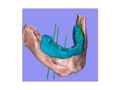 Implant Surgical Guide Systems | Dentalcompare.com