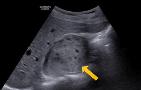 An Aberrant Case of Pheochromocytoma in a Young Adult Presenting With ...