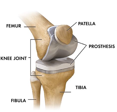 new knee replacement options