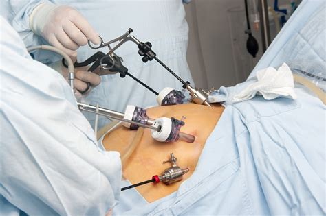 CPAP vs Laparoscopic Gastric Banding Surgery for Obstructive Sleep Apnea