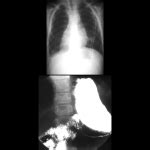 Heterotaxy Syndrome | Pediatric Radiology Reference Article | Pediatric Imaging | @pedsimaging