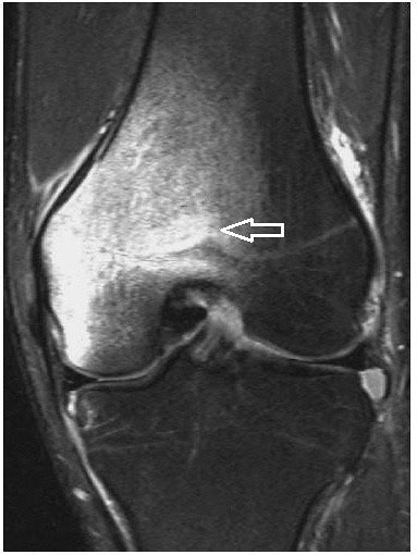 Bruised Ankle Bone: Causes & Treatment Guide!