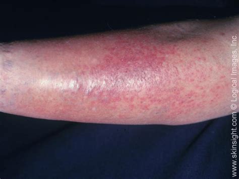 Stasis Dermatitis | National Eczema Association