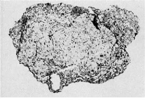 Figure 1 from Pathology of intrathecal phenol injection in man ...