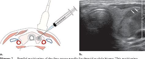 Figure 7 from US-guided fine-needle aspiration of thyroid nodules: indications, techniques ...