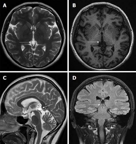 Evaluation of pineal cysts with magnetic resonance imaging