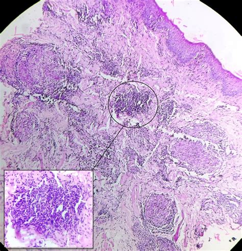 Dermoscopy in the diagnosis and assessment of treatment response in granulomatous cheilitis ...