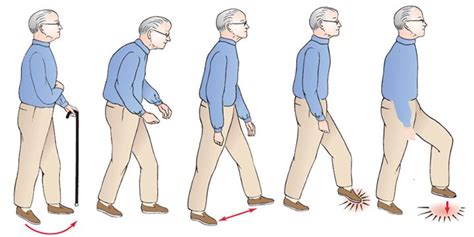 Why is Gait important for your Daily living? | TriBeCa Care | Neurological disorders ...