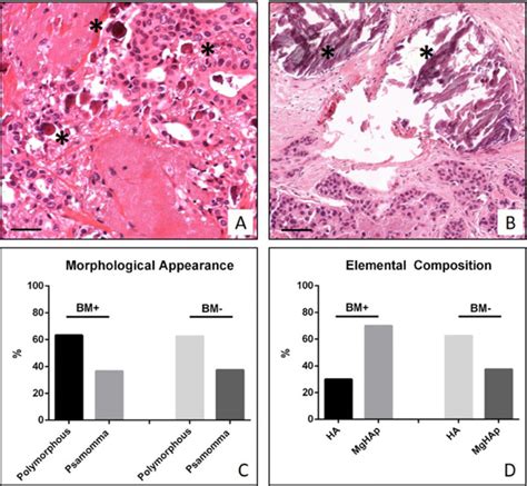 Can microcalcifications’ characteristics predict the risk of breast cancer metastasis to bone?