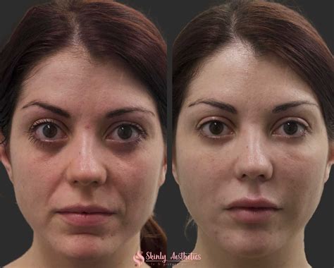 Smile Line Fillers - Before & After Results at Skinly