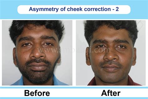 Cheekbone Reduction Surgery in India | Cheek Augmentation