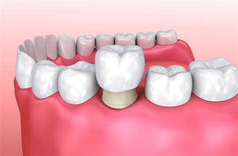 Dental Crown Types: Which Material is Best for You?