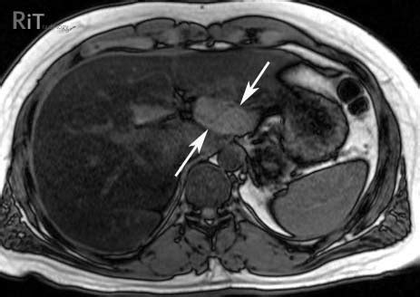 RiT radiology: Focal Fat Sparing