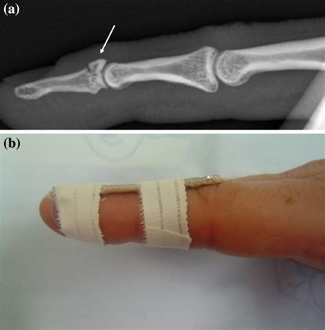 (a) Lateral radiograph of a mallet fracture (b) Dorsal | Open-i