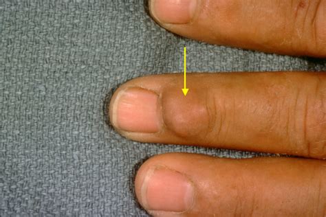 Tendon Sheath Cyst Finger