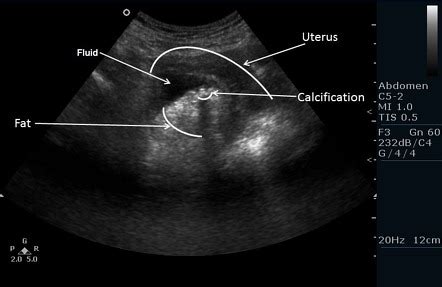 Mature cystic ovarian teratoma | Image | Radiopaedia.org