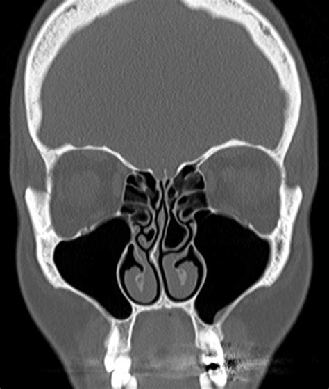 Endoscopic Sinus Surgery - Dr Jeeve ENT Specialist