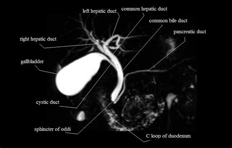 MRI MRCP Anatomy| Free MRI Coronal Cross Sectional Anatomy of the Biliary System