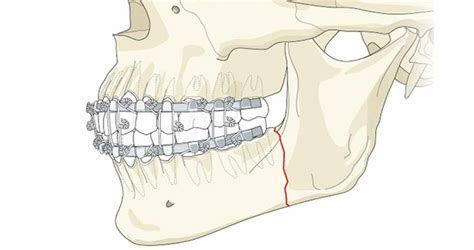 Types Of Jaw Fractures