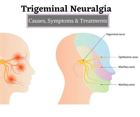 Trigeminal Neuralgia – Causes, Symptoms and Treatments | The Prolotherapy Clinic Hadapsar, Pune