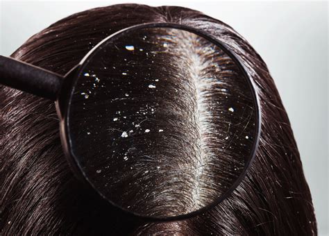 How To Get Rid Of Dandruff | Causes & Treatment | StrengthBuzz