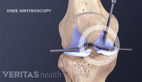 Types of Knee Surgery for Arthritis Treatment | Arthritis-health