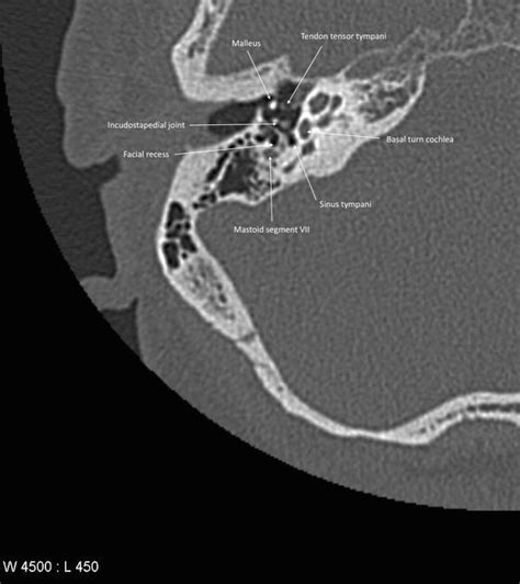 The petrous part of the temporal bone (or more simply petrous temporal bone) forms the part of ...