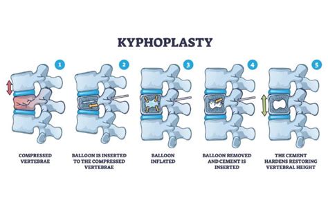 Kyphoplasty: Procedure, Purpose, Results, Cost, Price, Indications, Recovery