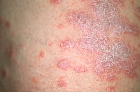 erythema elevatum diutinum - pictures, photos