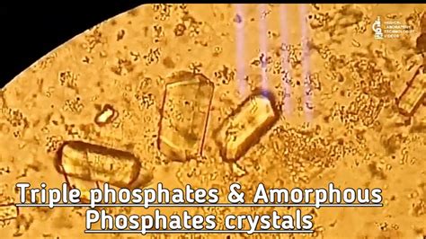 Triple Phosphate & Amorphous Phosphates Crystal in Urine.View at 10X & 40 X.crystals in urine ...