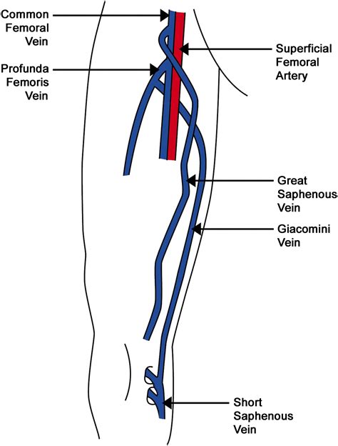 Case Report: A Rare Orientation of Femoral Artery and Vein - EJVES Extra