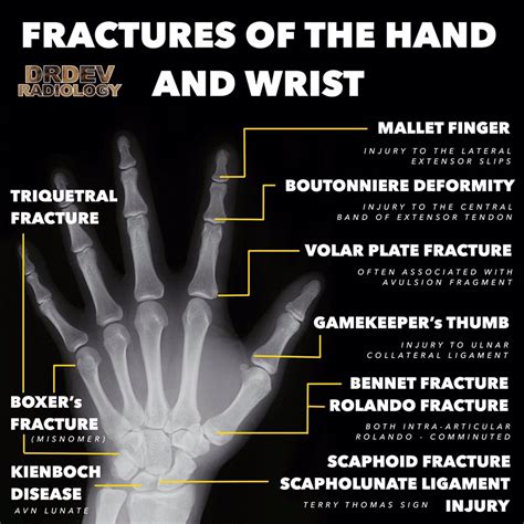 Common Hand Fractures on X-Ray Mallet finger - injury ... | GrepMed