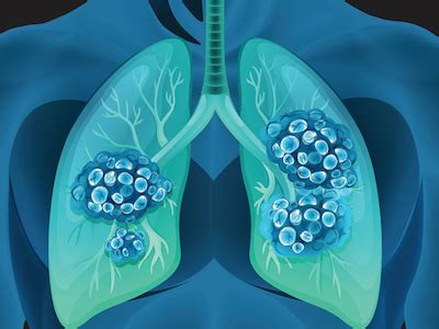 Stage 4 Lung Cancer: What You Should Know