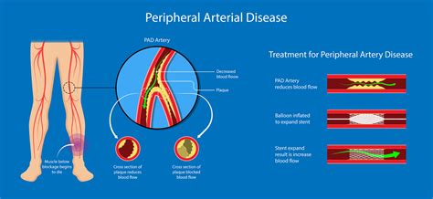 Peripheral Arterial Disease - DrCRaghu