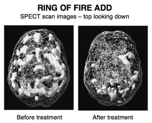 Ring of Fire | Amen Clinics Amen Clinics