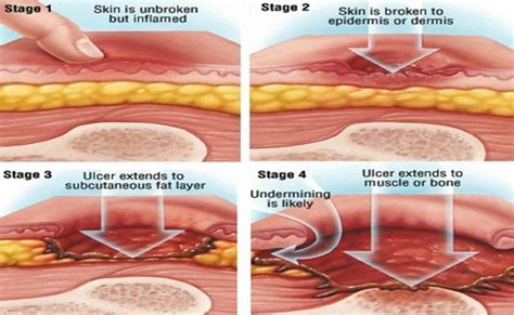 Bed Sores Pressure Ulcer Causes Stages Prevention Pressure Ulcer – Step ...