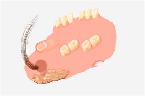 Teratoma: o que é, sintomas, causas e tratamento - Tua Saúde