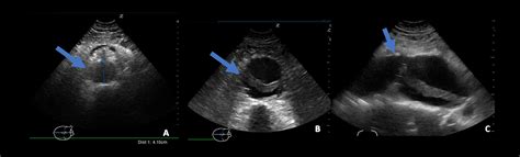 Thoracic Aortic Aneurysm Measured By Point Of Care Ultrasound | My XXX ...