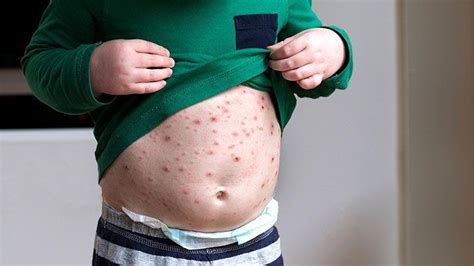 Chickenpox Symptoms and Diagnosis